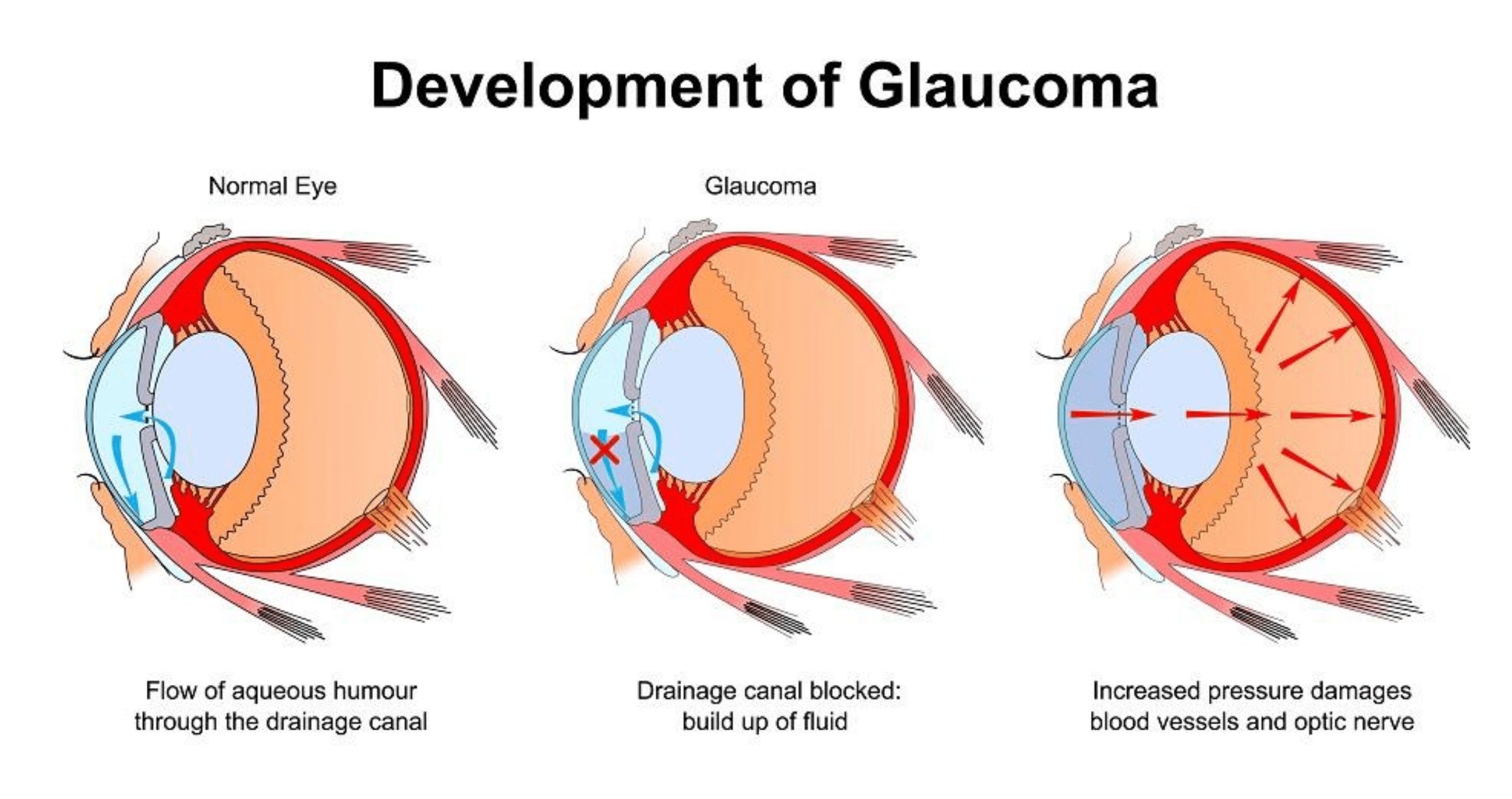 Que significa glaucoma